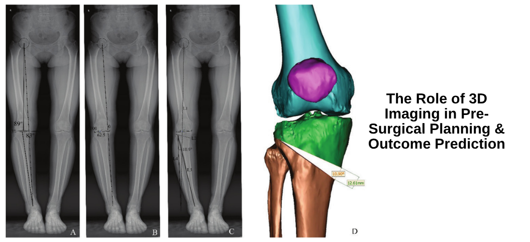 The Role of 3D Imaging in Pre-Surgical Planning & Outcome Prediction
