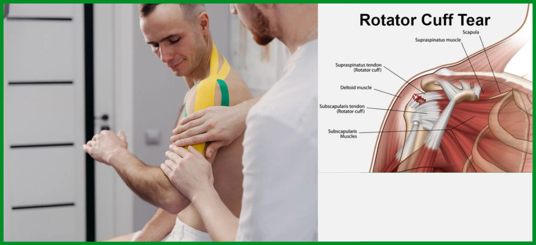 Navigating Rotator Cuff Repairs: Minimally Invasive Strategies